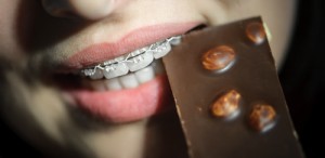 braces and chocolate